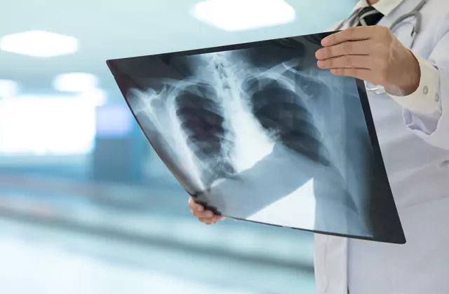 Pulmonary Embolism