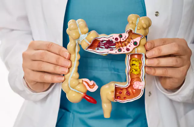 Colorectal Cancer